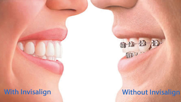 How Invisalign® Works  Orthodontist in Omaha, NE