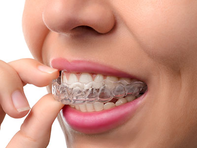 The image shows a person with a smile, holding their finger near their teeth, which are fitted with clear braces.